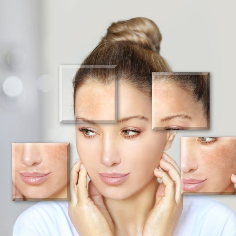 BBL (Broad Band Light) Geniş Bant Işık Tedavisi